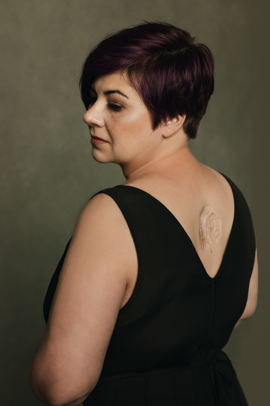 Portrait of a woman with cancer scars on her back